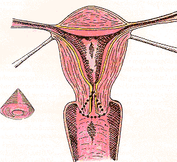 A méhnyakrák szűrés jelentősége